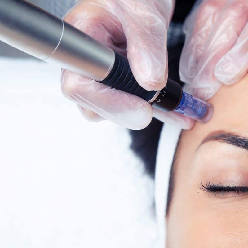 Morpheus8 treatment Malvern Link from Lipo Sculpt - Book in today!