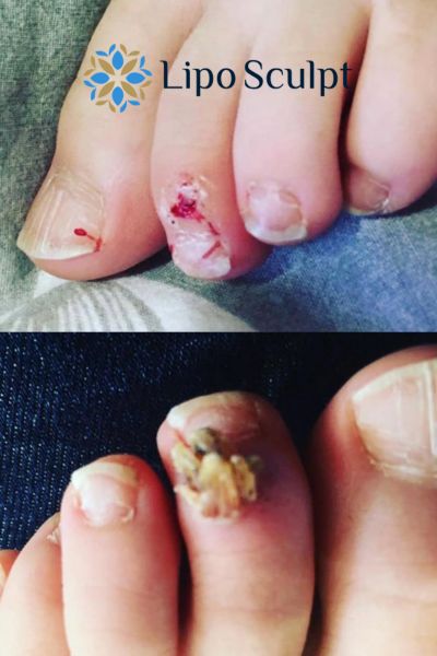 Wart removal customer results from Lipo Sculpt Malvern Link